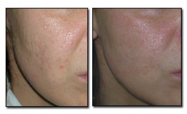 HYDRAFACIAL:   