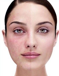 HYDRAFACIAL: 